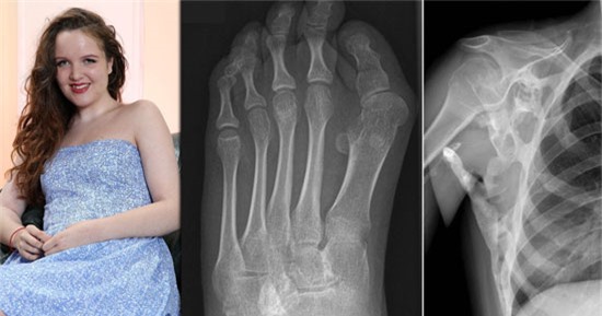 Nỗi lo "hóa đá" của thiếu nữ mang căn bệnh kỳ lạ