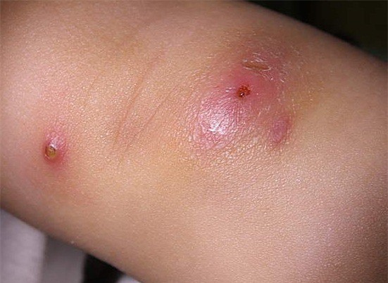 Nguy cơ tử vong vì nặn mụn nhọt tại nhà