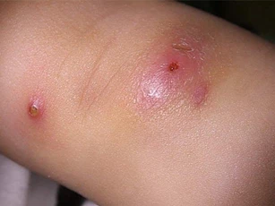 Nguy cơ tử vong vì nặn mụn nhọt tại nhà