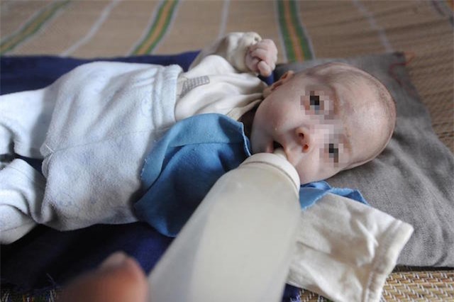 Xót xa bé trai 3 tháng tuổi chỉ nặng 2kg do mắc chứng bệnh lạ