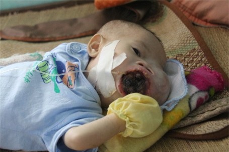 Hà Tĩnh: Sự sống mong manh của cháu bé 5 tháng tuổi bị u máu quai hàm