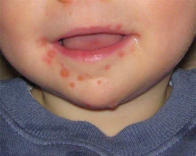 Những dấu hiệu bệnh tay chân miệng của trẻ nhỏ