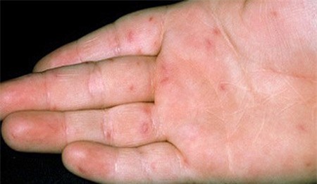 Cảnh giác với bệnh chân tay miệng ở trường học