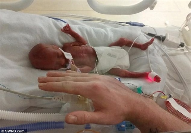 Sức sống kì diệu của bé gái sinh non nặng 480 gram