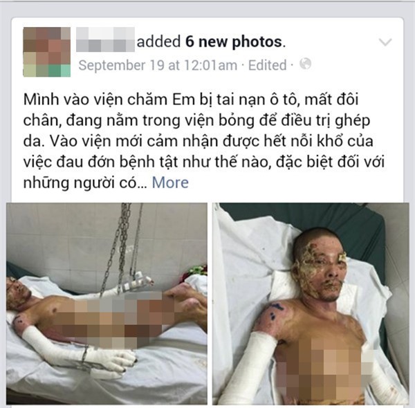 Cảnh đời khốn khó của người cha vì cứu con mà bị bỏng nặng toàn thân