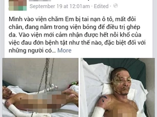Cảnh đời khốn khó của người cha vì cứu con mà bị bỏng nặng toàn thân