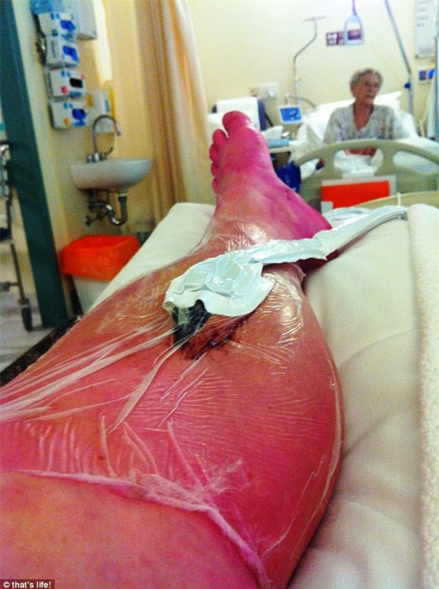 Một phụ nữ suýt bị cưa chân vì... đi bộ 10 cây số