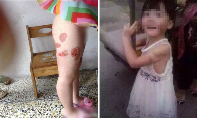 Phẫn nộ cảnh bố "tra tấn" con gái ruột 4 tuổi tàn nhẫn bằng thìa inox