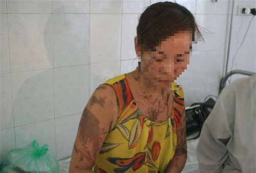 "Đứng ngồi không yên" kẻ lạ mặt tạt axit vào phụ nữ và bé gái