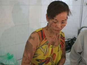 "Đứng ngồi không yên" kẻ lạ mặt tạt axit vào phụ nữ và bé gái