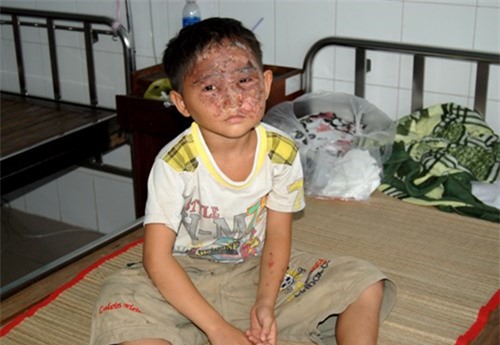Một bé trai bị bỏng nặng vì chơi đèn lồng trung thu