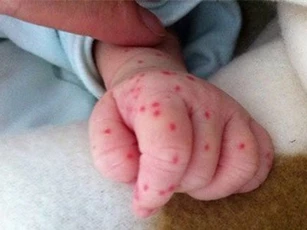 Cách phòng tránh sốt xuất huyết cho trẻ nhỏ