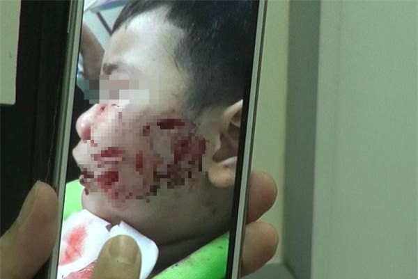 Bé trai 3 tuổi bị chó dữ cắn nát mặt, khâu 200 mũi