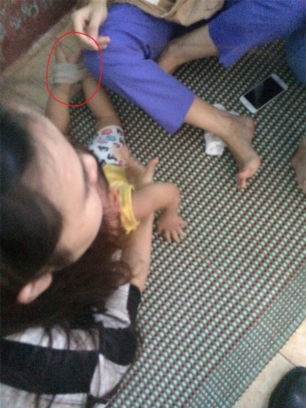 Vụ bảo mẫu nhét giẻ trói chân tay: Cháu bé bị sốt, sợ hãi và hoảng loạn