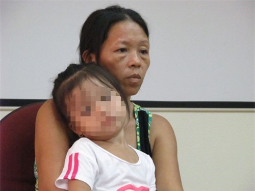 Bé gái teo thực quản vì uống nhầm dung dịch kiềm