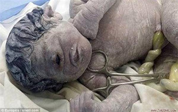 Bé trai ra đời với một mắt và không có mũi vì mẹ uống nhầm thuốc