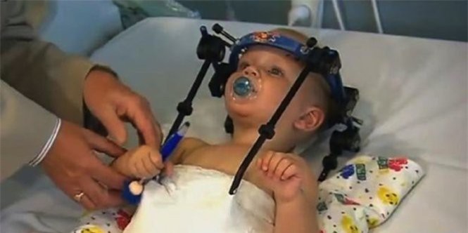 Ca phẫu thuật nối đầu thần kỳ cho bé trai 16 tháng tuổi ở Úc