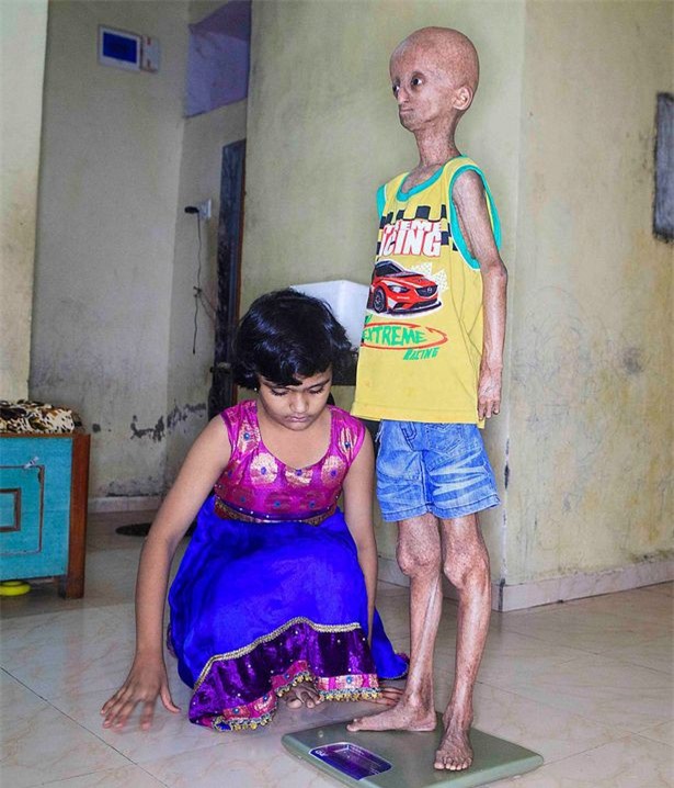 Mắc bệnh lạ, cậu bé 14 tuổi biến dạng thành ông cụ