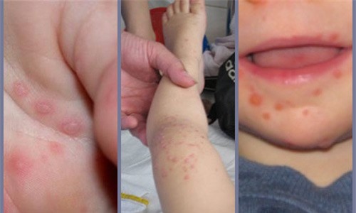 Chân tay miệng tấn công trường học mầm non