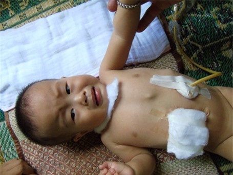 Thương bé 11 tháng tuổi bị teo thực quản và không có hậu môn