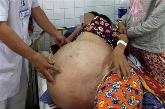 Phẫu thuật khối u buồng trứng “khổng lồ” nặng đến 40 kg