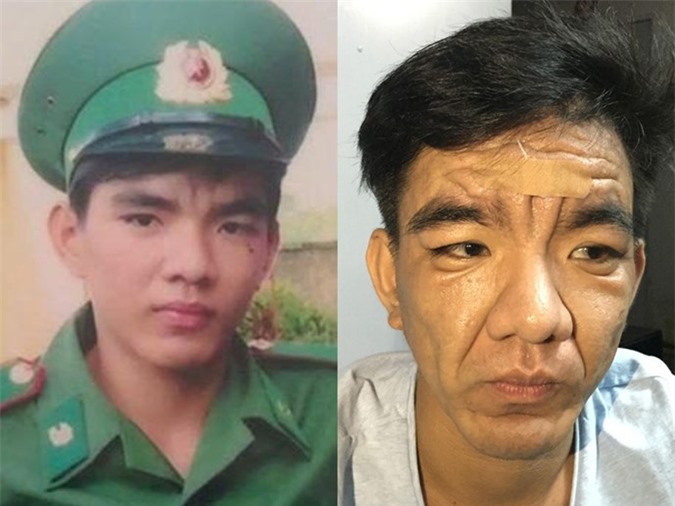 Cà Mau: Chàng trai 23 tuổi bất ngờ biến thành "ông lão"