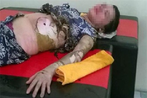 Ghen tuông, chồng tưới xăng đốt biến vợ thành "ngọn đuốc sống"