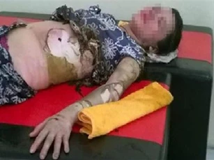 Ghen tuông, chồng tưới xăng đốt biến vợ thành "ngọn đuốc sống"