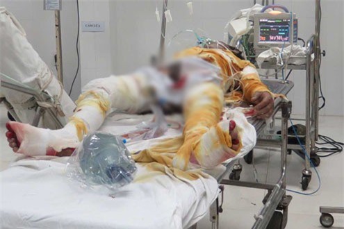 Quảng Nam: Căn nhà phát nổ, hai vợ chồng bỏng nặng toàn thân