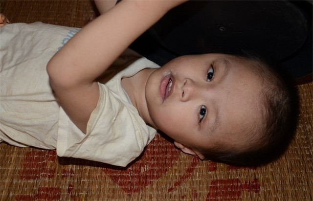 Thương bé 3 tuổi không cha, bị đục thủy tinh thể và tim bẩm sinh