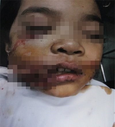 Bình Phước: Bé gái 8 tuổi bị chó cắn nát mặt 