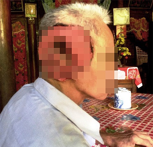 “Cam tẩu mã”- chứng bệnh lạ và nguy hiểm