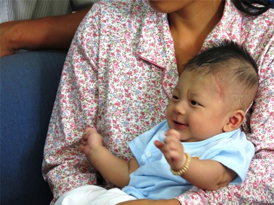 Bé trai bị đâm xuyên sọ: Lanh lợi, đáng yêu ngày tái khám 