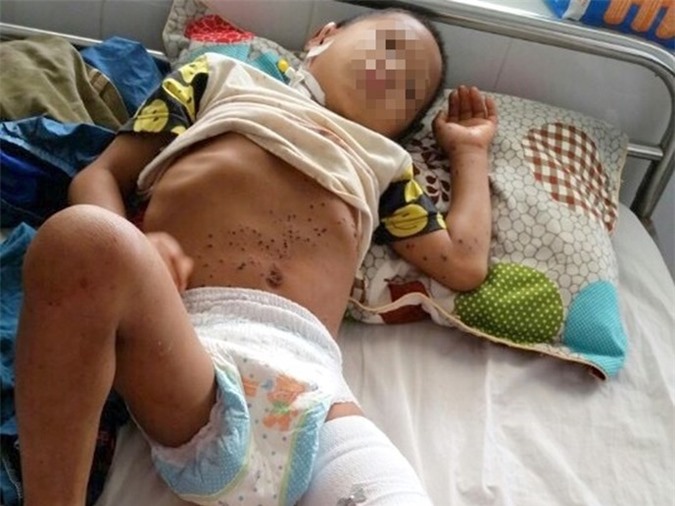 Nghịch kíp nổ do bố nhặt về, con trai 8 tuổi suýt mất mạng