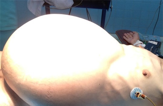 Phẫu thuật thành công khối u 19 kg trong bụng người phụ nữ