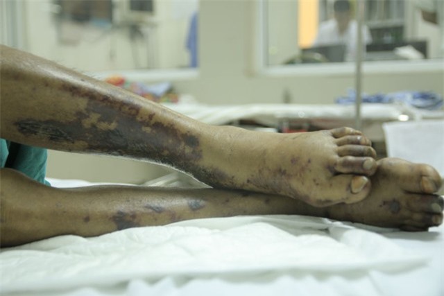 Ăn lợn sữa chết, một thanh niên nguy kịch vì liên cầu khuẩn