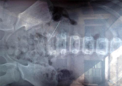 Quảng Bình: Bé gái bị kim khâu 5cm đâm xuyên bụng