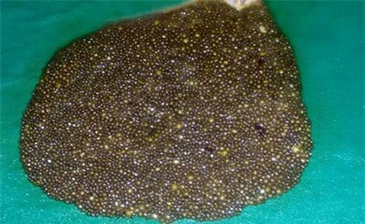 Ấn Độ: Phát hiện 12.000 viên sỏi trong túi mật một phụ nữ