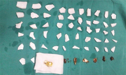 Phẫu thuật gắp 59 mảnh sành trong bụng bệnh nhân