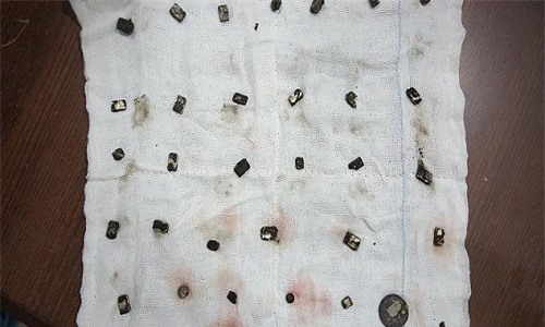 Kỳ quái bé 3 tuổi nghiện ăn nam châm và tiền xu