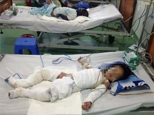 Xót xa bé gái 2 tuổi nguy kịch vì ngã vào nồi nước sôi