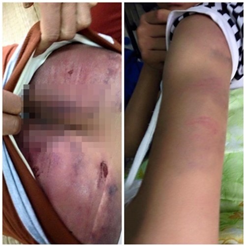 Bắc Giang: Bố đẻ đánh bầm dập con gái 14 tuổi 