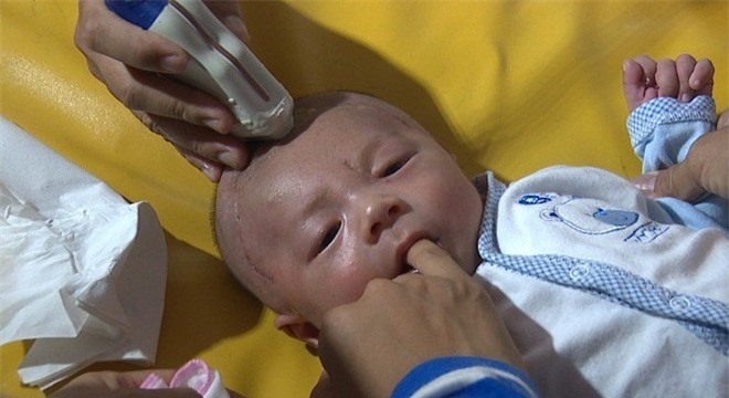 Bé trai bị đâm xuyên sọ: Xuất hiện ổ vi trùng trong não