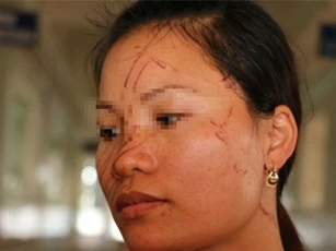 Hai mẹ con bị hàng xóm rạch mặt dã man