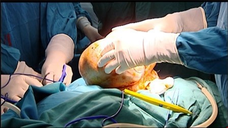 Khối u nặng hơn 3kg trên mặt người phụ nữ được phẫu thuật thành công