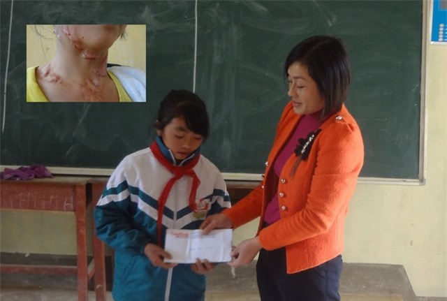 Gặp lại cô bé bị bệnh lạ giữa mùa hoa tam giác mạch