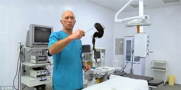 Phát hiện búi tóc hơn 1kg trong dạ dày bé gái