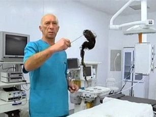 Phát hiện búi tóc hơn 1kg trong dạ dày bé gái