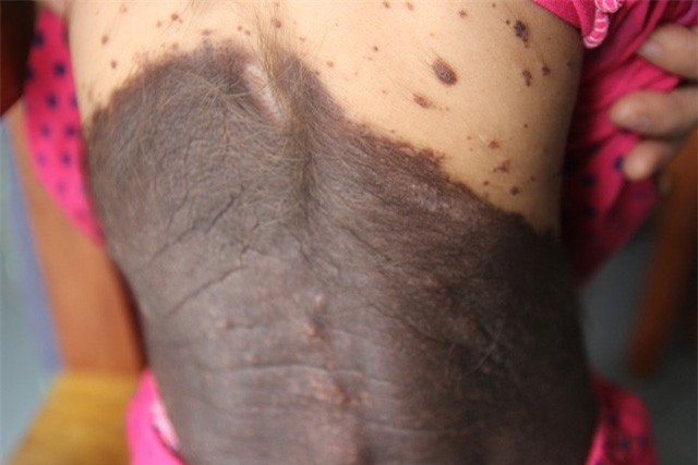 Rớt nước mắt với bé 5 tuổi mọc lông như người rừng, không rõ giới tính