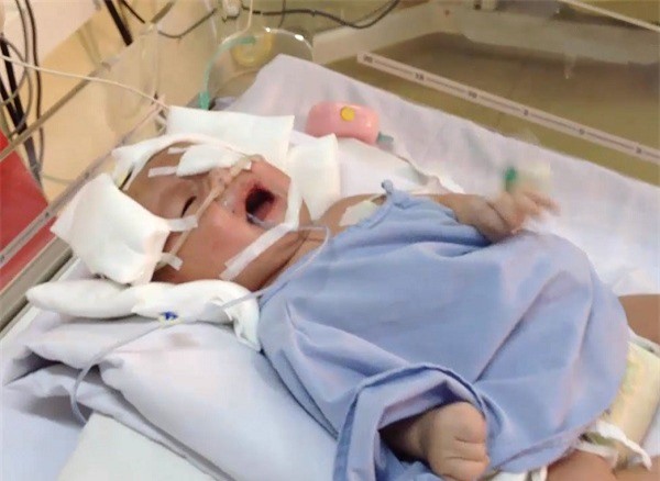 Bé trai bị đâm xuyên sọ: Não nhiều dịch ứ đọng, phải mổ lần 3